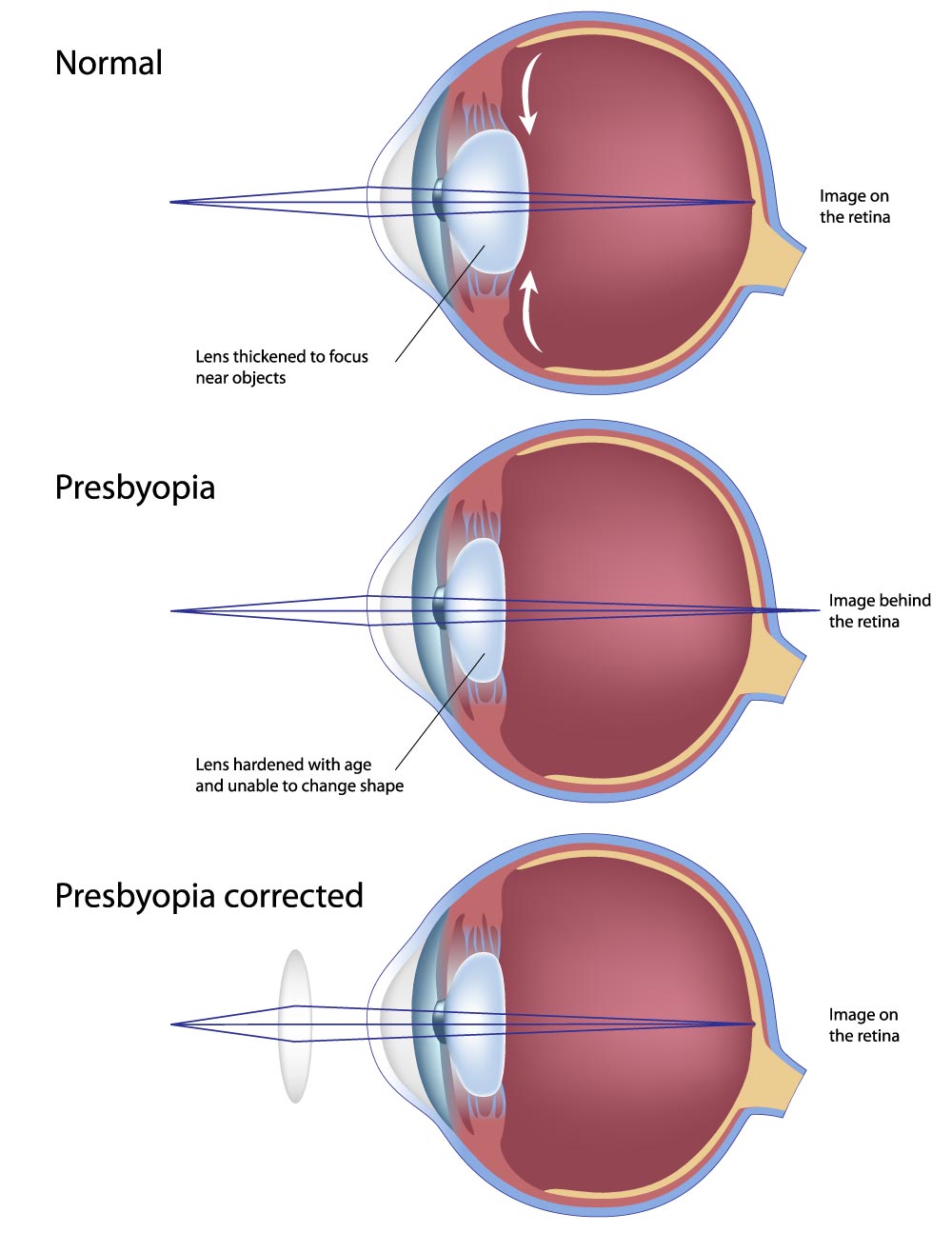presbyopia explained