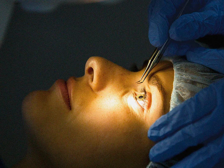 lasik eye surgery