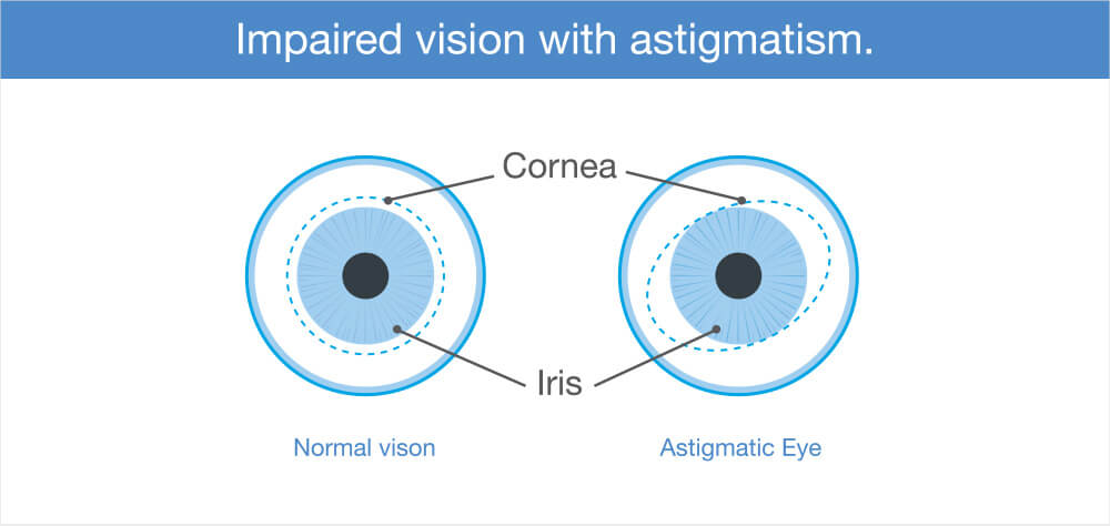Astignatic eye